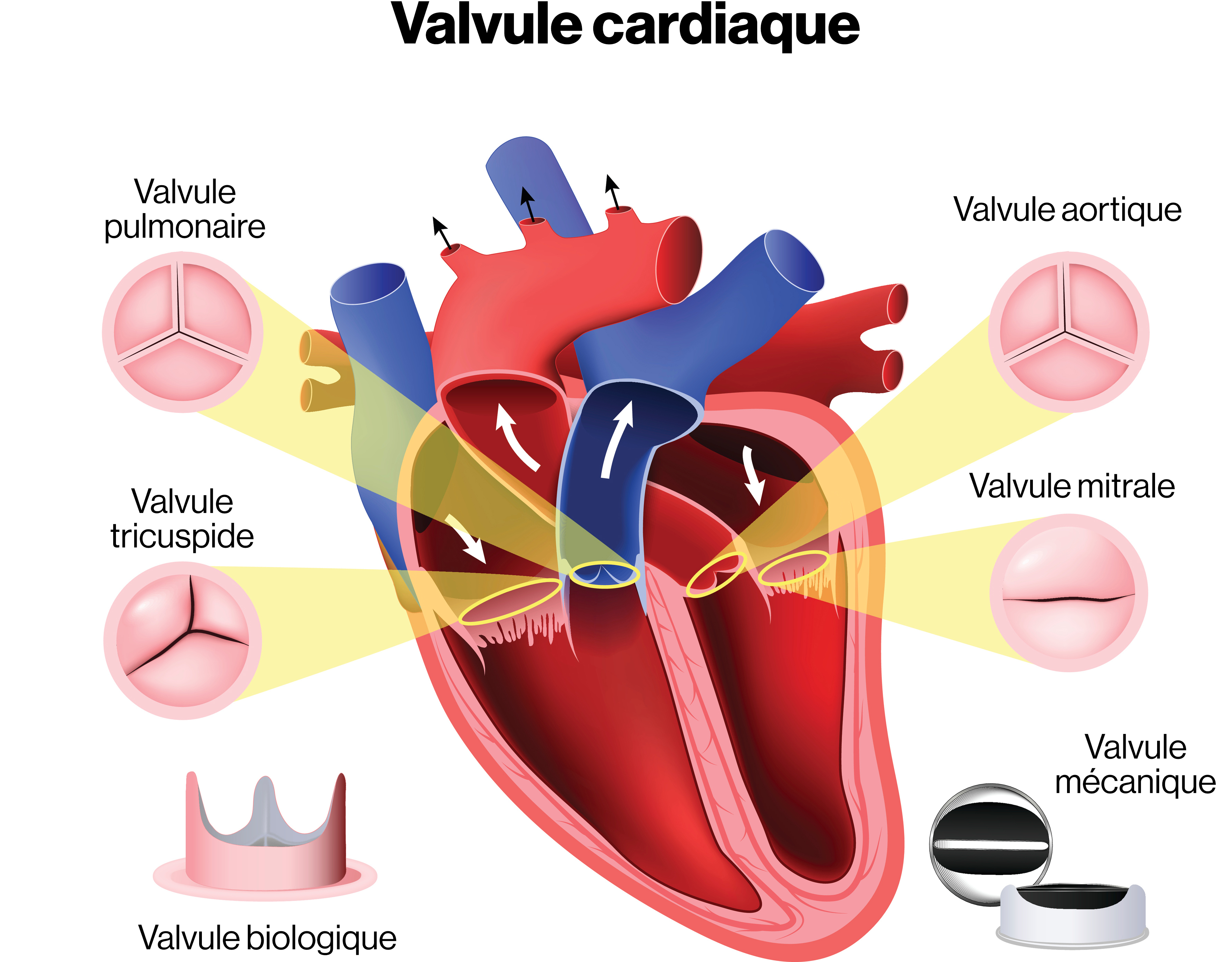 Valvulopathie Fondation des maladies du c ur et de l AVC